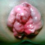 Signs and symptoms of stage 3 hemorrhoids pictures