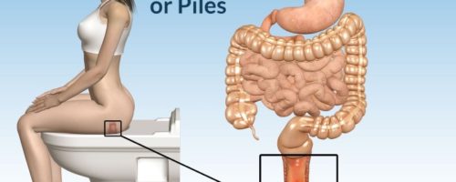 Female hemorrhoids photos