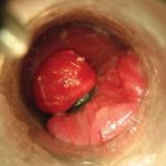 Male hemorrhoids treatment pictures