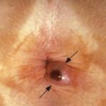 Hemorrhoids in children pictures