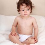 Baby with chickenpox pictures