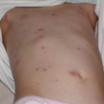 Chicken pox baby pictures