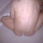 Chicken pox in babies images
