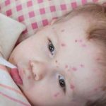 Chicken pox in babies pictures