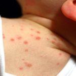 Chicken pox in infants pictures
