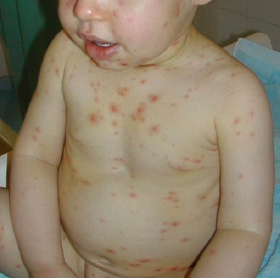 Chicken pox pictures on toddlers