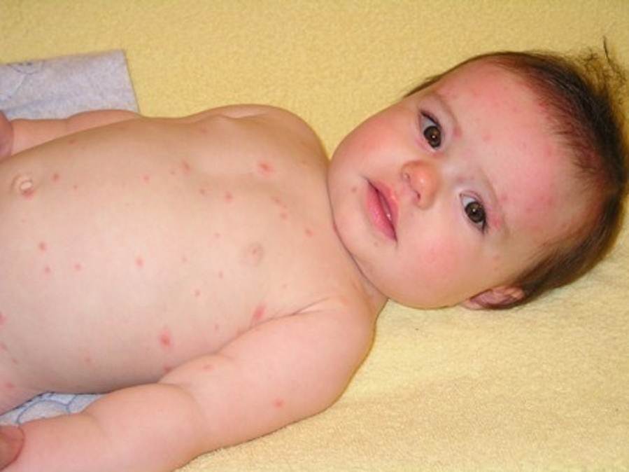 Chicken pox pictures toddler