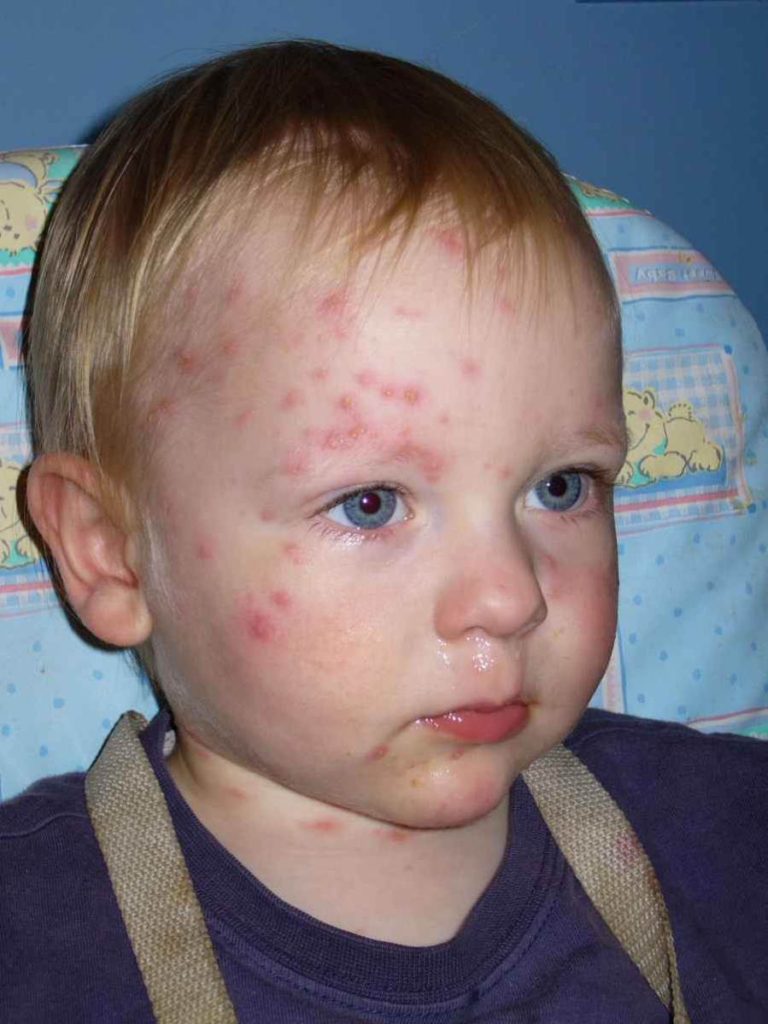 Chicken pox rash in babies pictures | Symptoms and pictures