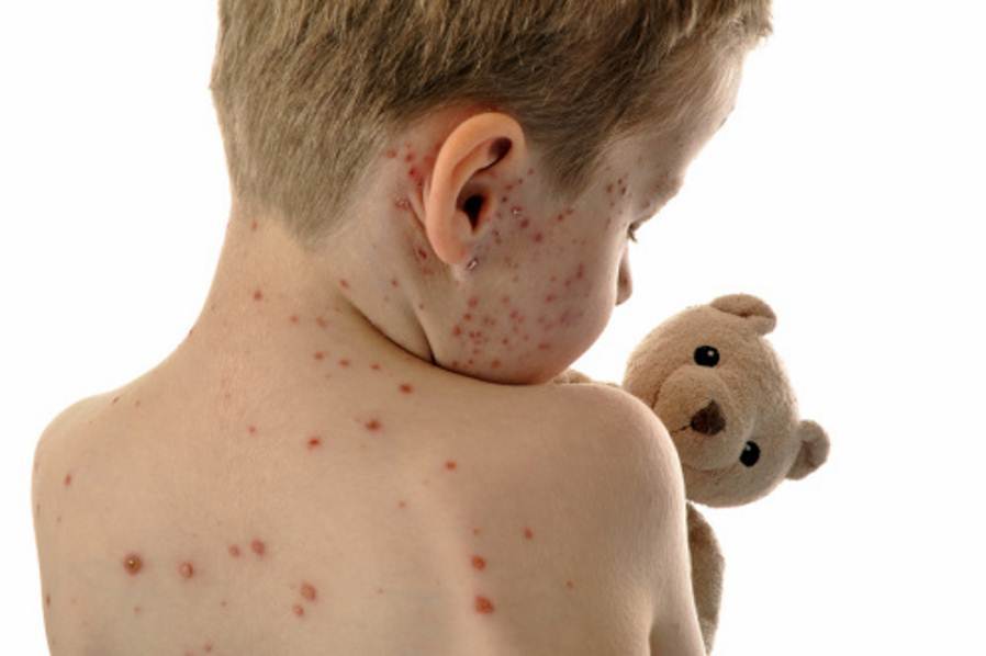 Chicken pox symptoms in babies pictures