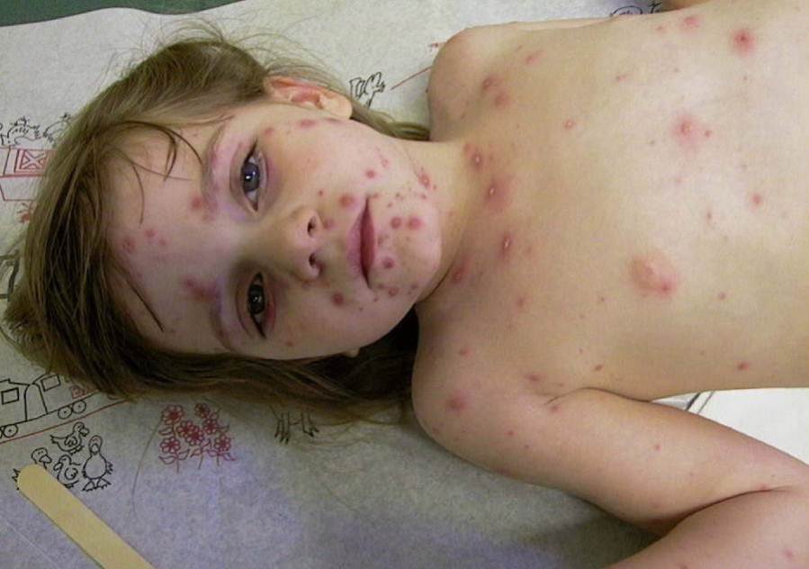 Chicken pox symptoms in children pictures