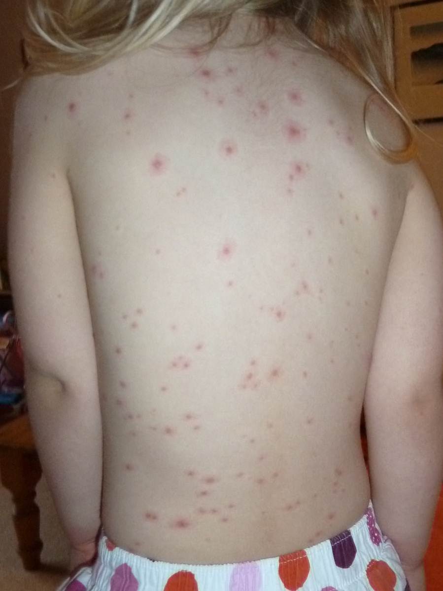 Chicken pox symptoms in kids pictures