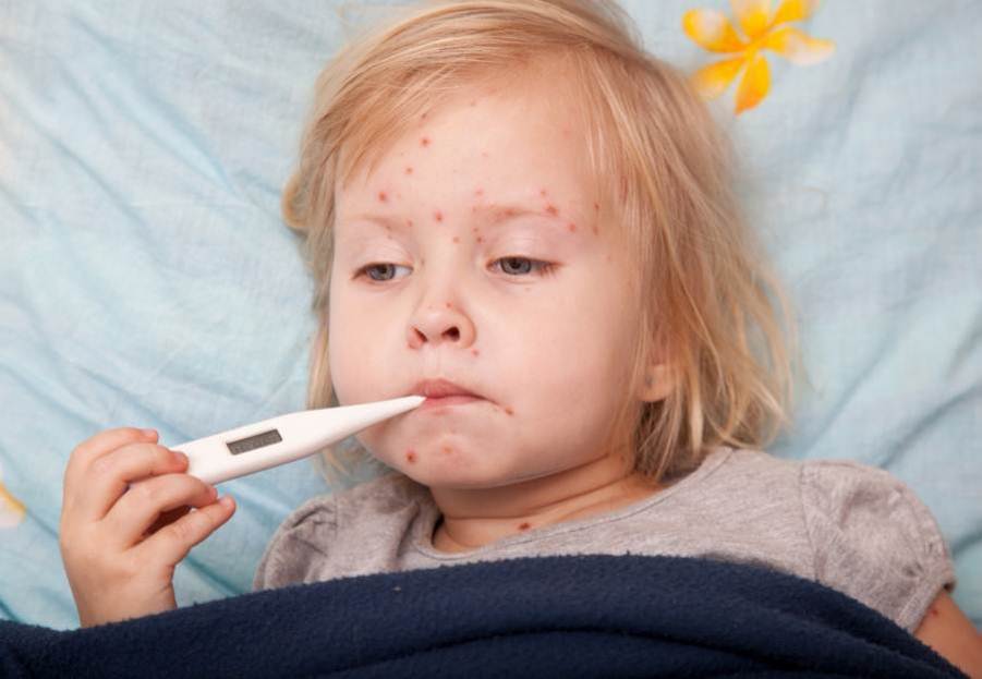 Chickenpox in children images