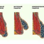 Combined hemorrhoids pictures