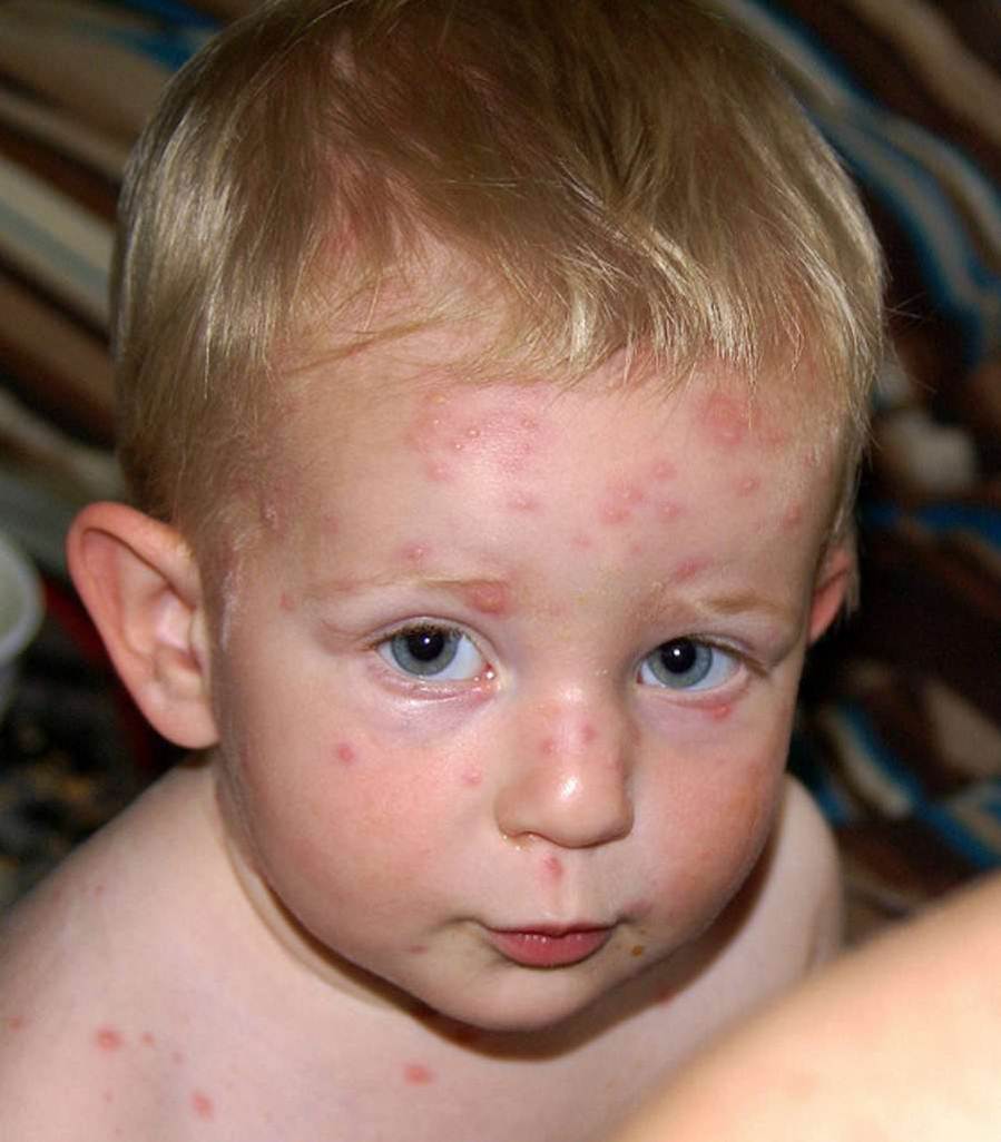 Early signs of chickenpox in babies pictures