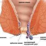 External piles pictures a comprehensive view