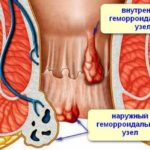Images of thrombosed hemorrhoids
