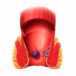 Internal hemorrhoids photos