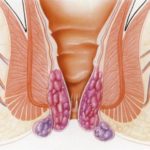 Pictures of external hemorrhoids