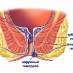 Pictures of hemorrhoid skin tags