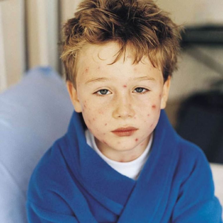 Symptoms of chickenpox in children pictures | Symptoms and pictures