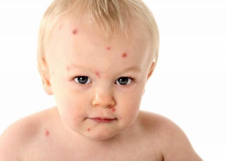 Symptoms of chickenpox in kids pictures | Symptoms and pictures