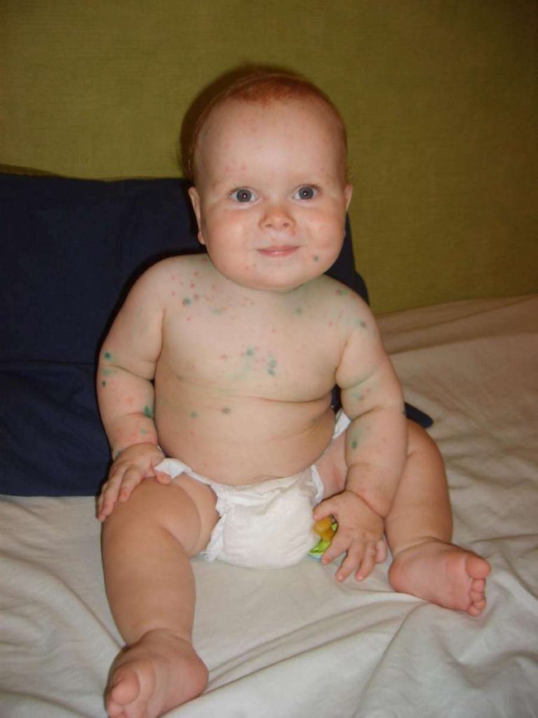 Symptoms Of Chickenpox In Toddlers Pictures Symptoms And Pictures