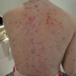 Adults with chickenpox pictures