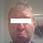 Can adults get chicken pox pictures