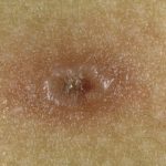 Chicken pox after vaccine pictures