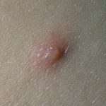 Chicken pox blisters pictures