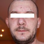 Chicken pox for adults pictures