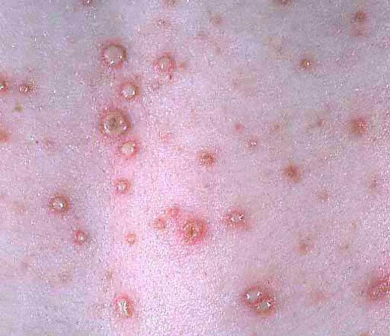 Return to Chickenpox in adults symptoms pictures. 