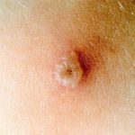 Chicken pox images early stages