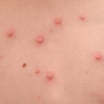 Chicken pox pictures early stages