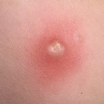 Chicken pox pustules pictures