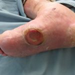 Diabetes images