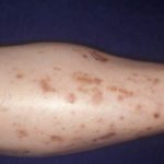 Diabetes mellitus images