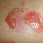 Diabetic blisters images