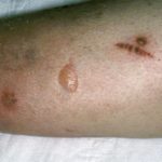 Diabetic blisters pictures 1