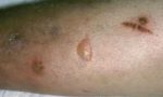 Diabetic Dermopathy Pictures, What Do Diabetic Sores Look Like 