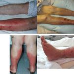 Diabetic dermopathy pictures 1