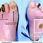 Diabetic foot ulcer pictures 1