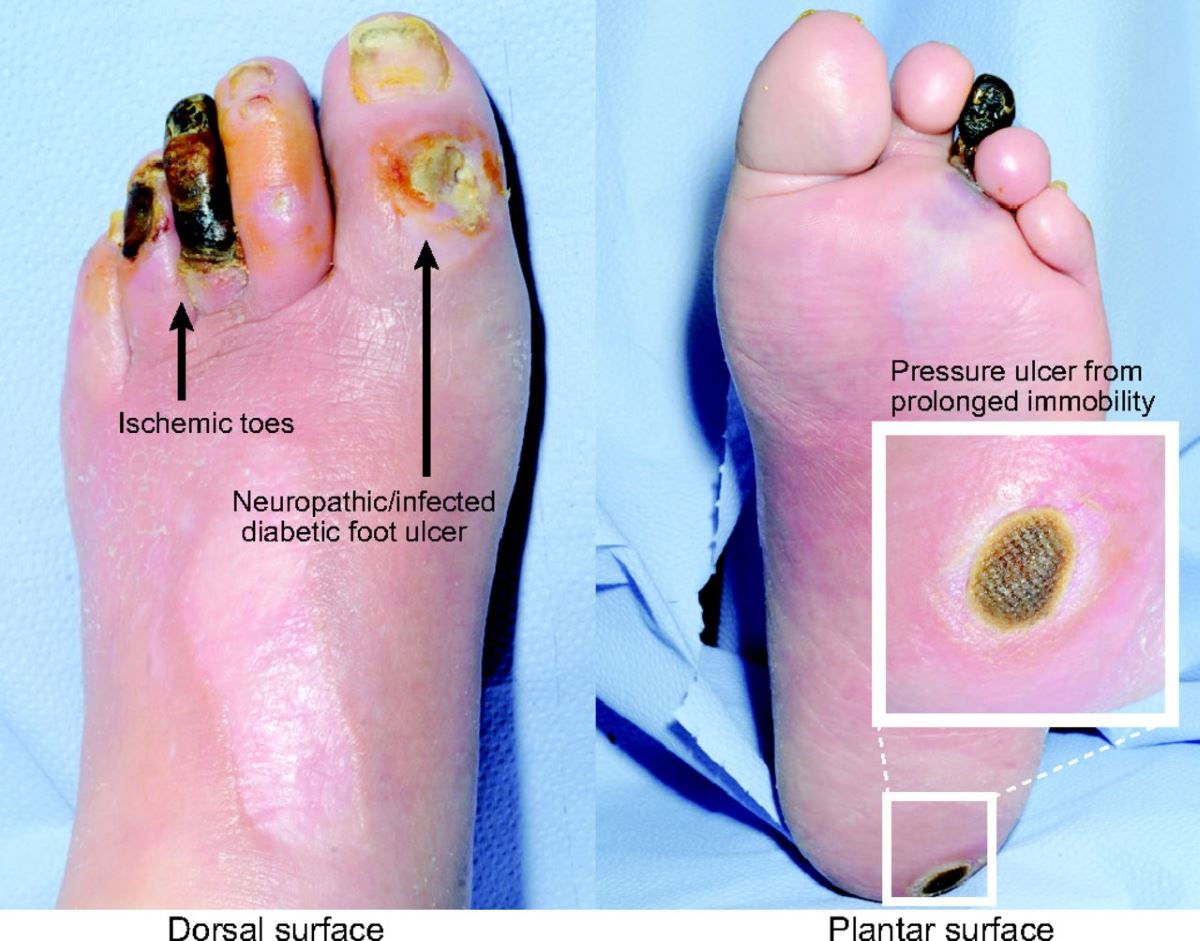 diabetic foot ulcer case study nursing