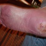 Diabetic heel ulcer pictures