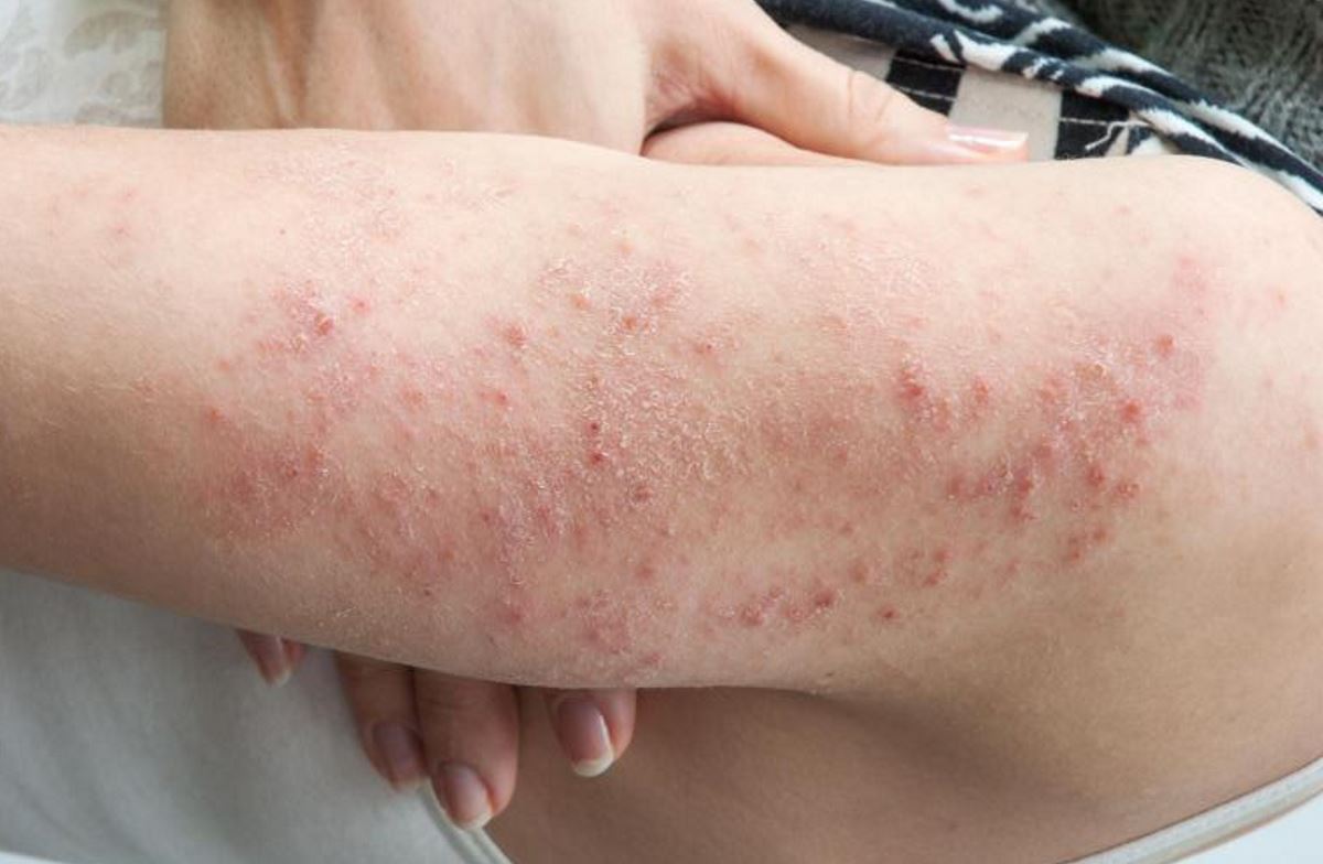 Diabetic Rash Pictures 1 Symptoms And Pictures 2306