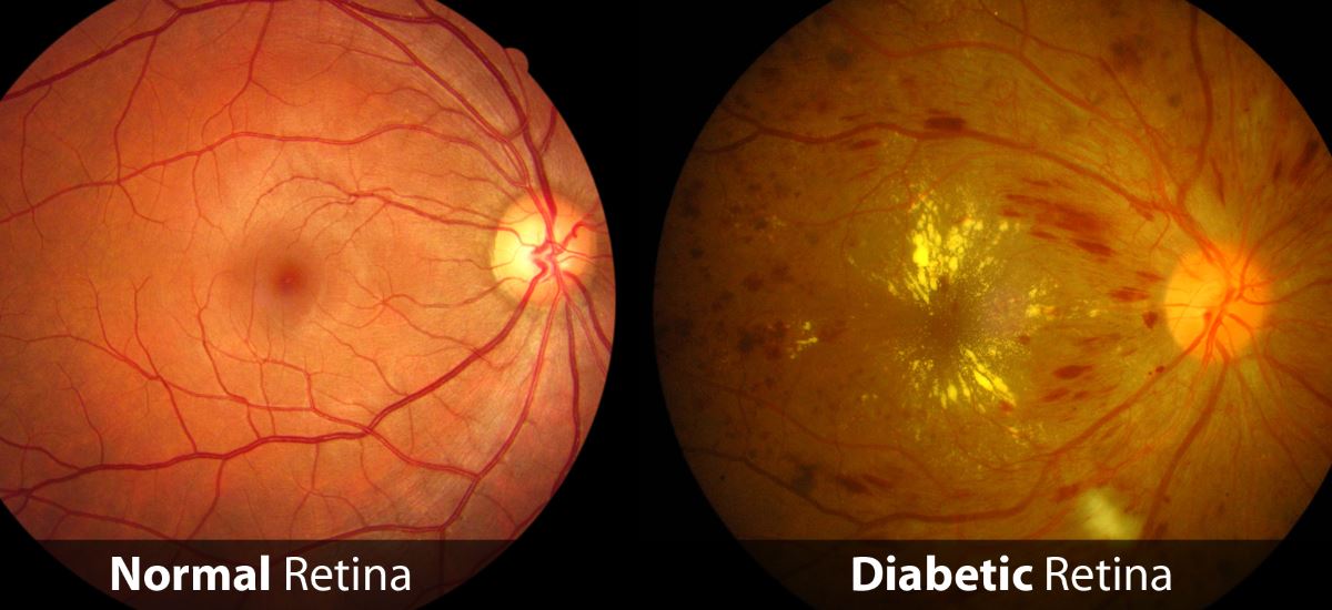 Diabetic retinopathy pictures