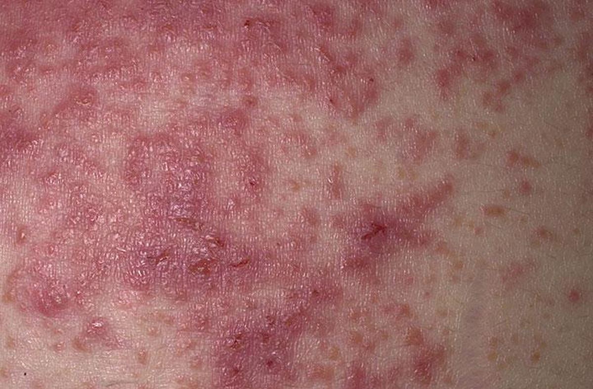 Diabetic Skin Conditions Pictures 1 Symptoms And Pictures 9262