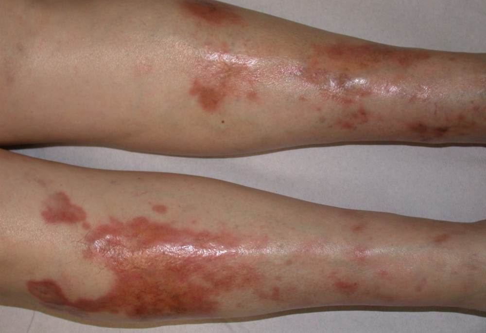 Diabetic sores images