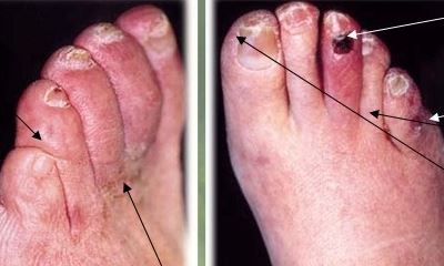 Diabetic toes pictures