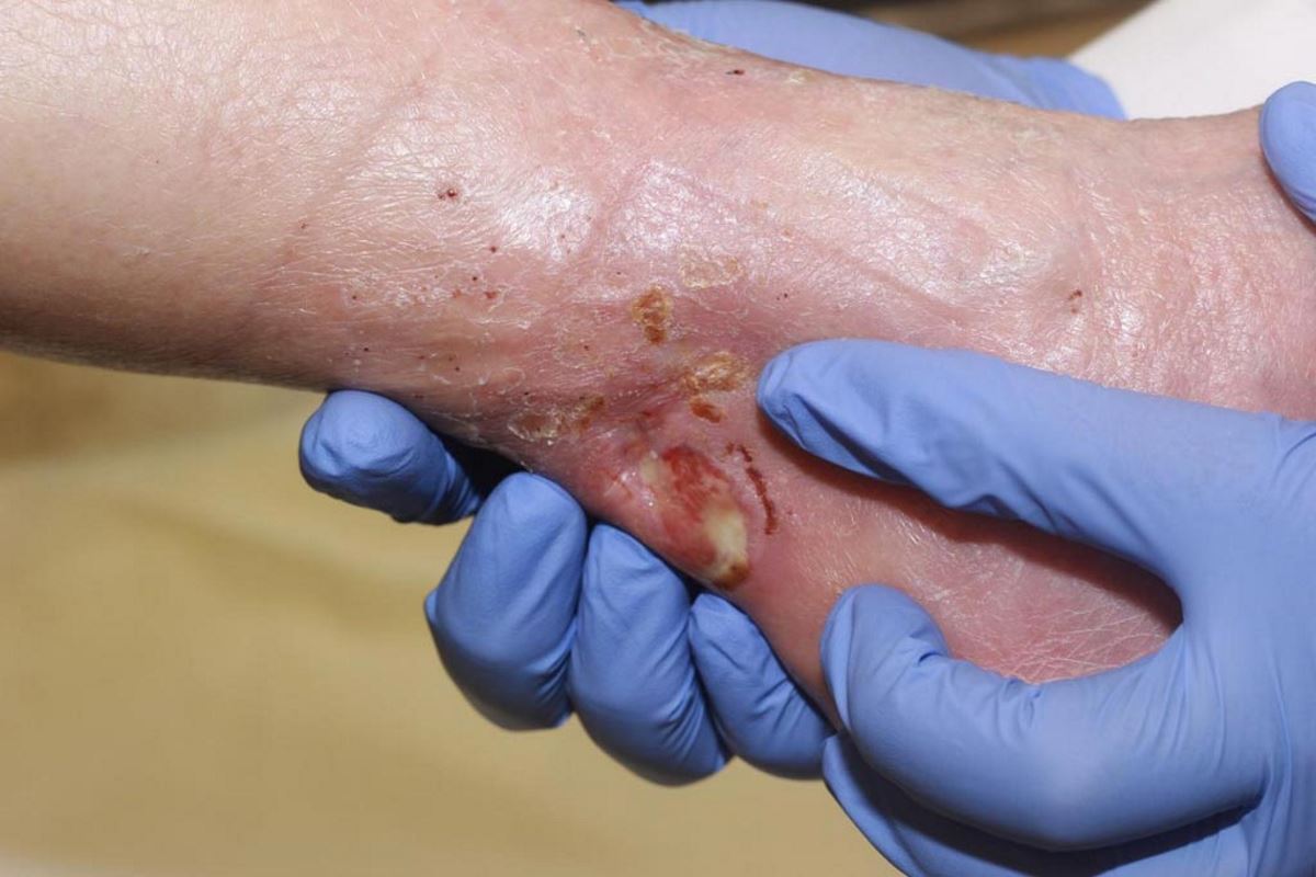 Diabetic wounds pictures